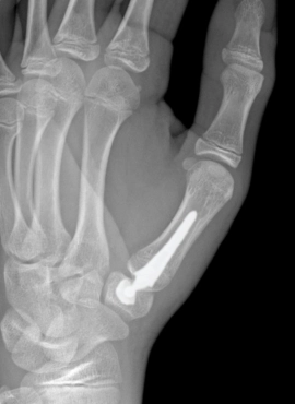 Artroplastia del Pulgar en Guadalajara